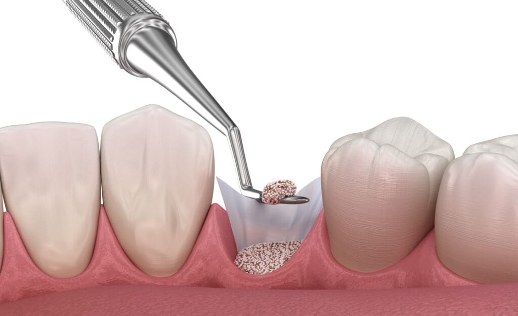 bone grafting for dental implants in wilmington de