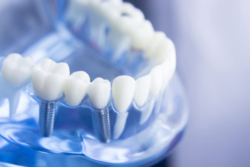faqs about dental implants