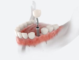 Can You Get a Dental Implant Years After Tooth Loss? in Delaware