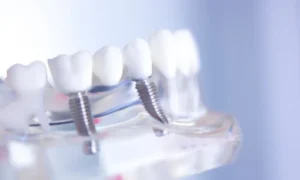 The Benefits of Dental Implants for Tooth Loss in Wilmington, DE