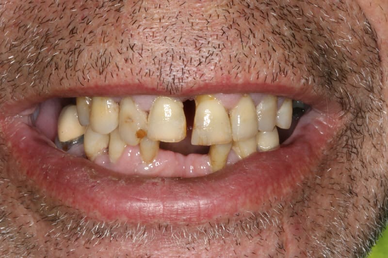 Joe Dental Before
